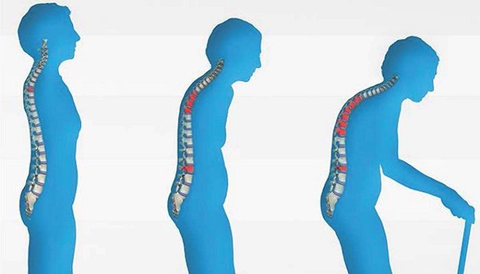 Osteoporoz (Kemik Erimesi) Nedir ? 1 Osteoporoz (Kemik Erimesi) Nedir ?