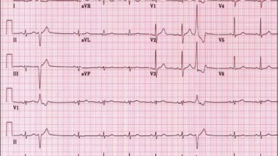 EKG kullanimi ve tanimi
