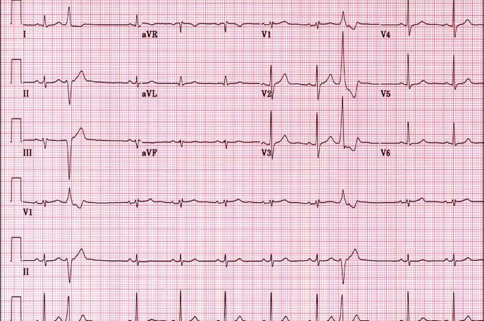 EKG kullanimi ve tanimi