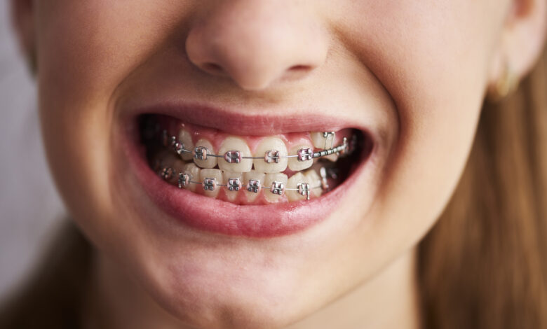 Ortodontist Nedir? 1 ortodontist nedir 1
